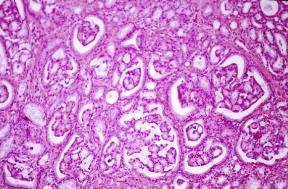 adenocarcinoma de prostata histologia ecografia transrectal prostatica
