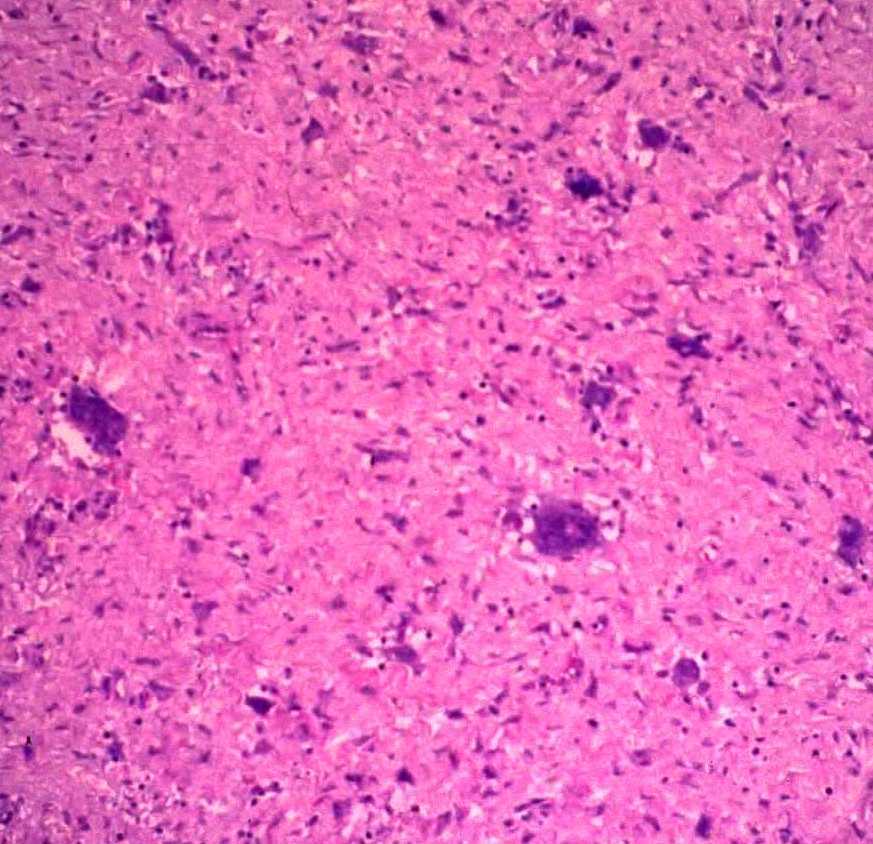 Giant-cell fibroblastoma - Wikipedia