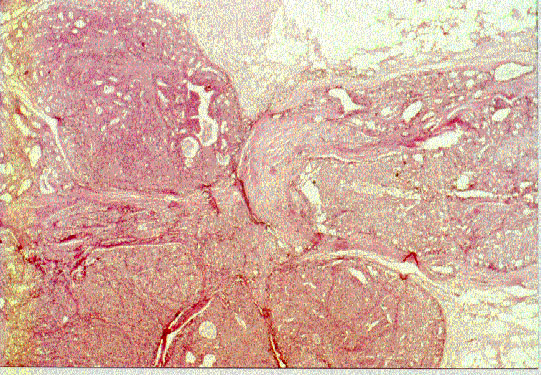 papiloma intraductal atipico)