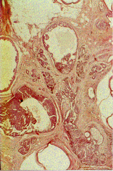 papiloma intraductal con hiperplasia atipica
