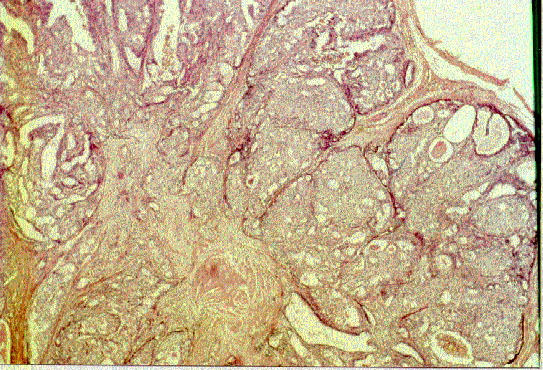 papilloma intraductal multiple