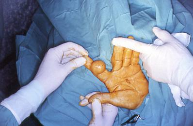 Imagen de Lipoma fusocelular en mano: una localizacin rara que dificulta el diagnstico.