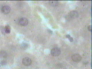 Imagen de Esteatosis Heptica en Conejos Alcohlicos Tratados con Dieta Rica en Colesterol.