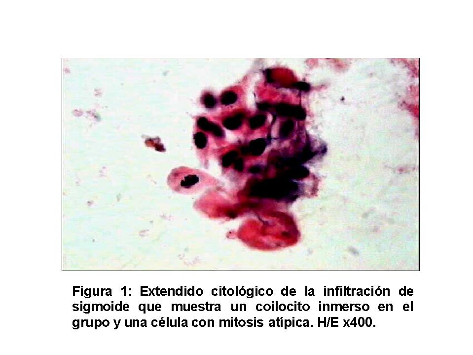 Papiloma rectal. Infecţia cu virusul HPV şi riscul de cancer