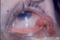 Imagen de Rinosporidiosis ocular en la regin de Transkei, Sudfrica.