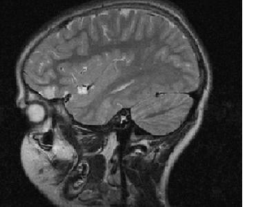 Imagen de Tumor Neuroepitelial Disembrioplstico