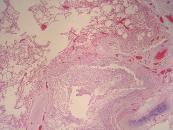 Imagen de Candidiasis sistmica en paciente no inmunodeprimido tras cateterismo cardiaco