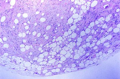 Imagen de Lipoma fusocelular en mano: una localizacin rara que dificulta el diagnstico.