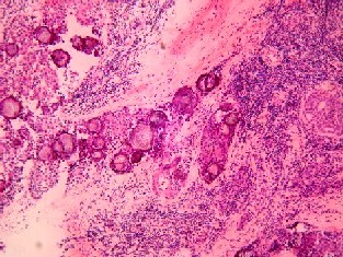 Imagen de Carcinoma Papilar del Tiroides, variante Esclerosante Difusa. Presentacion de un caso
