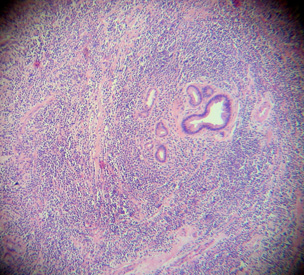 Imagen de Ictericia obstructiva por tumor de va biliar. Evolucin.