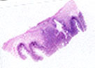 Imagen de Angiosarcoma metastsico del intestino delgado.