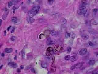 Imagen de Diagnstico histopatolgico de 98 casos de Micosis Profunda en el Hospital Dom Orione, Brasil.