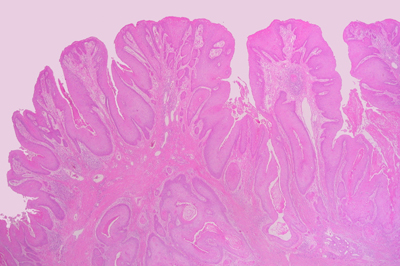 Imagen de Carcinoma epidermoide anal. Una expresin clnica de la infeccin por virus del papiloma humano.