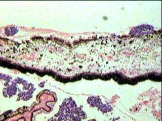 Imagen de Retinoblastoma. Frecuencia y conducta de algunas variables pronosticas en 53 pacientes.  