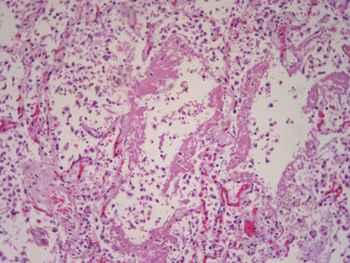 Imagen de Candidiasis sistmica en paciente no inmunodeprimido tras cateterismo cardiaco