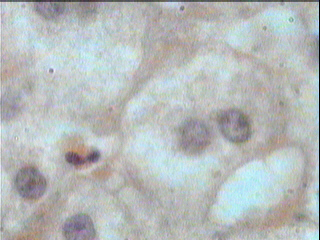 Imagen de Esteatosis Heptica en Conejos Alcohlicos Tratados con Dieta Rica en Colesterol.