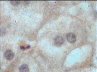 Imagen de Esteatosis Heptica en Conejos Alcohlicos Tratados con Dieta Rica en Colesterol.