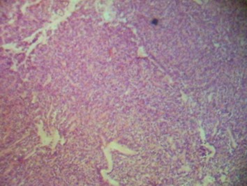 Imagen de Tumor  slido qustico papilar del pncreas, presentacin de un caso.