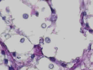 Imagen de Diagnstico histopatolgico de 98 casos de Micosis Profunda en el Hospital Dom Orione, Brasil.