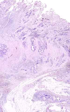 Imagen de Carcinoma micropapilar infiltrante de mama en varn, asociado con adenocarcinoma primario gstrico y colorrectal. Presentacin de un caso.