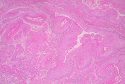 Imagen de Carcinoma epidermoide anal. Una expresin clnica de la infeccin por virus del papiloma humano.