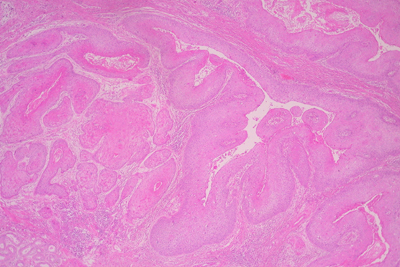 Imagen de Carcinoma epidermoide anal. Una expresin clnica de la infeccin por virus del papiloma humano.