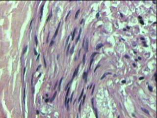 Imagen de Neuropata tomacular. Reporte de un caso