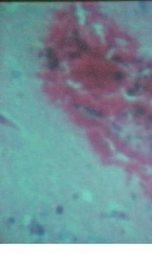 Imagen de La sepsis del Sistema Nervioso Central como complicacin en el traumatismo craneoenceflico