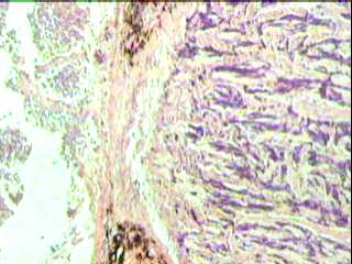 Imagen de Retinoblastoma. Frecuencia y conducta de algunas variables pronosticas en 53 pacientes.  