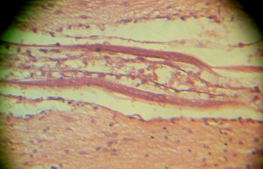 Imagen de Tres casos fallecidos con Meningitis eosinoflica causado por Angiostrongylus Cantonensis en la provincia de Villa Clara.