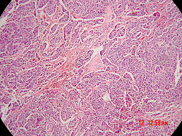 cancer vesicula biliar histologia)