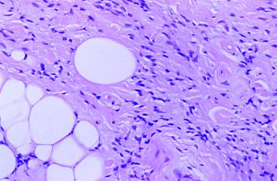 Imagen de Lipoma fusocelular en mano: una localizacin rara que dificulta el diagnstico.