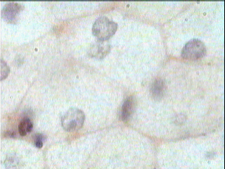 Imagen de Esteatosis Heptica en Conejos Alcohlicos Tratados con Dieta Rica en Colesterol.