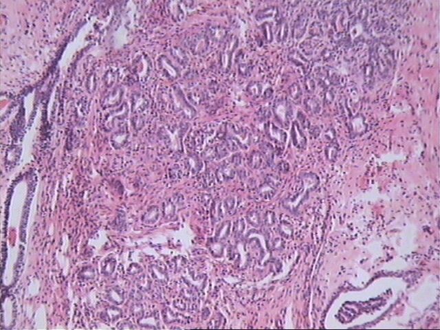 papiloma intraductal histologia