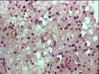 Imagen de Tumor Neuroepitelial Disembrioplstico