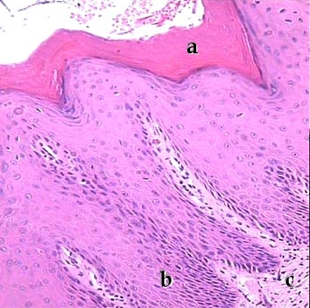 Imagen de Caracterizacin clnico-histopatolgica de la displasia epitelial y expresin de la oncoprotena p53 en la leucoplasia bucal