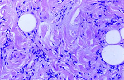 Imagen de Lipoma fusocelular en mano: una localizacin rara que dificulta el diagnstico.