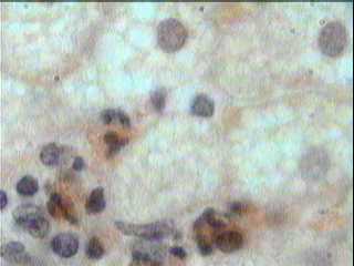 Imagen de Esteatosis Heptica en Conejos Alcohlicos Tratados con Dieta Rica en Colesterol.