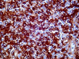 Imagen de Enfermedad de Cadena Pesada Gamma Asociada a Linfoma Linfoplasmacitico