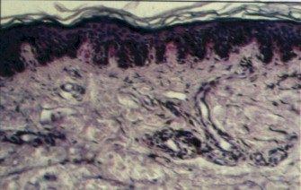 Imagen de Amiloidosis queratinocitica pigmentaria.Presentacin de un Caso.