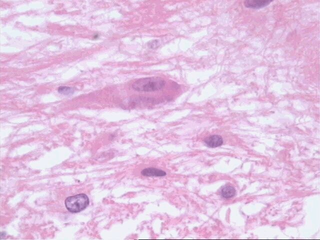 Imagen de Tumores Glioneuronales del Sistema Nervioso Central. A propósito de 3 casos.