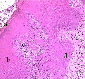 Imagen de Caracterizacin clnico-histopatolgica de la displasia epitelial y expresin de la oncoprotena p53 en la leucoplasia bucal