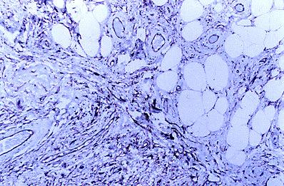 Imagen de Lipoma fusocelular en mano: una localizacin rara que dificulta el diagnstico.