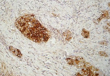Imagen de Carcinoma Papilar del Tiroides, variante Esclerosante Difusa. Presentacion de un caso