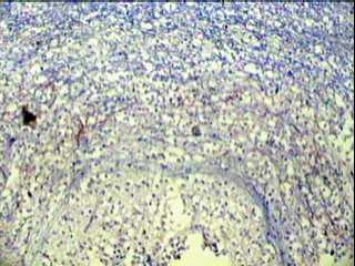 Imagen de Tumor Neuroepitelial Disembrioplstico