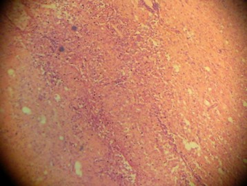 Imagen de Tres casos fallecidos con Meningitis eosinoflica causado por Angiostrongylus Cantonensis en la provincia de Villa Clara.