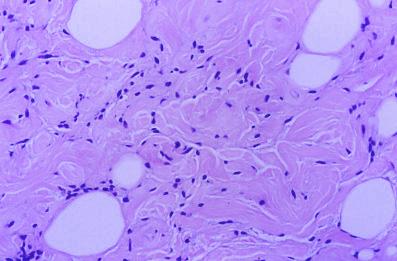 Imagen de Lipoma fusocelular en mano: una localizacin rara que dificulta el diagnstico.