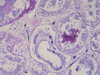 Imagen de Candidiasis sistmica en paciente no inmunodeprimido tras cateterismo cardiaco