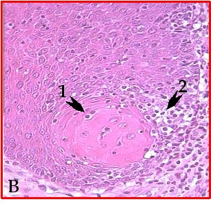 Imagen de Caracterizacin clnico-histopatolgica de la displasia epitelial y expresin de la oncoprotena p53 en la leucoplasia bucal