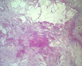 Imagen de Paciente de 40 aos con hipermenorrea.